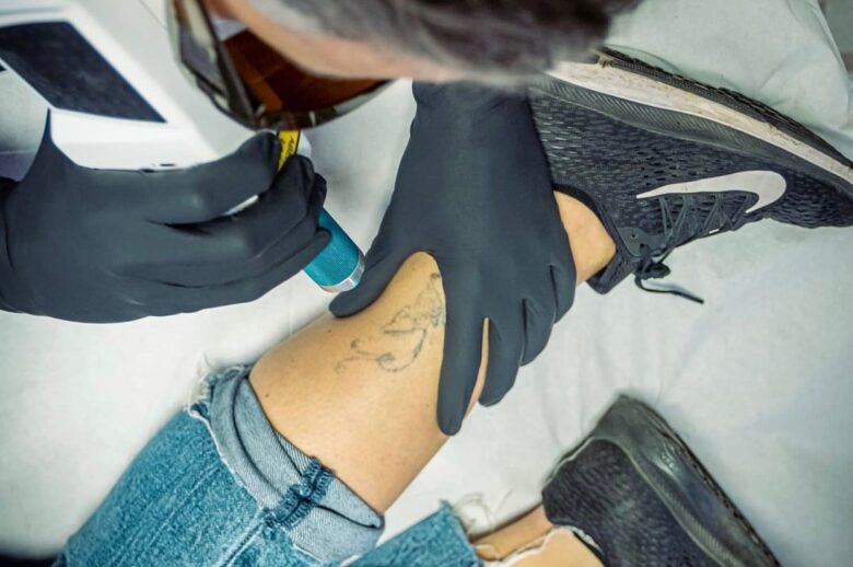 Borrar tatuajes con láser: nunca digas nunca